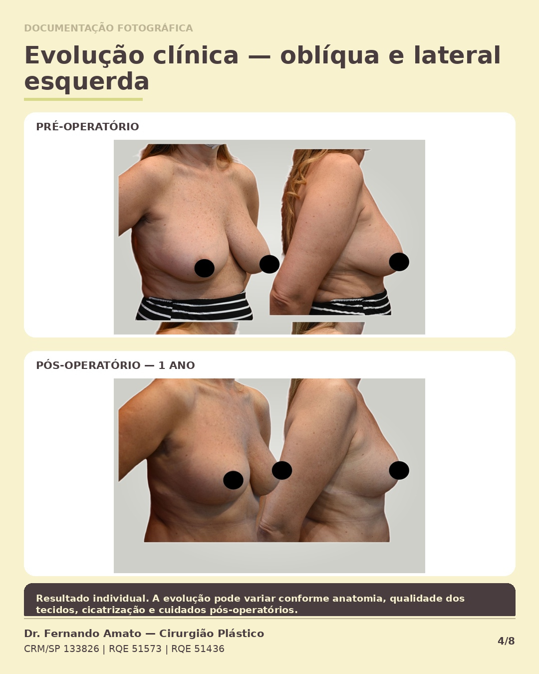 Fotografia clínica em vista oblíqua e lateral esquerda comparando pré-operatório e 1 ano de pós-operatório