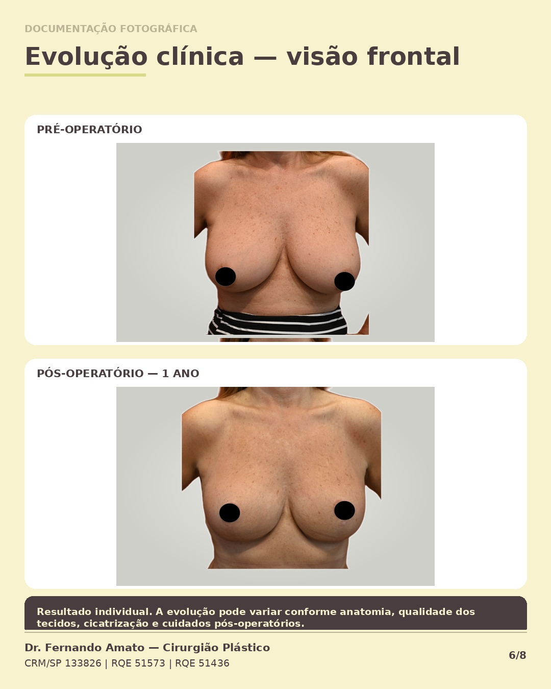 Fotografia clínica em vista frontal comparando pré-operatório e 1 ano de pós-operatório