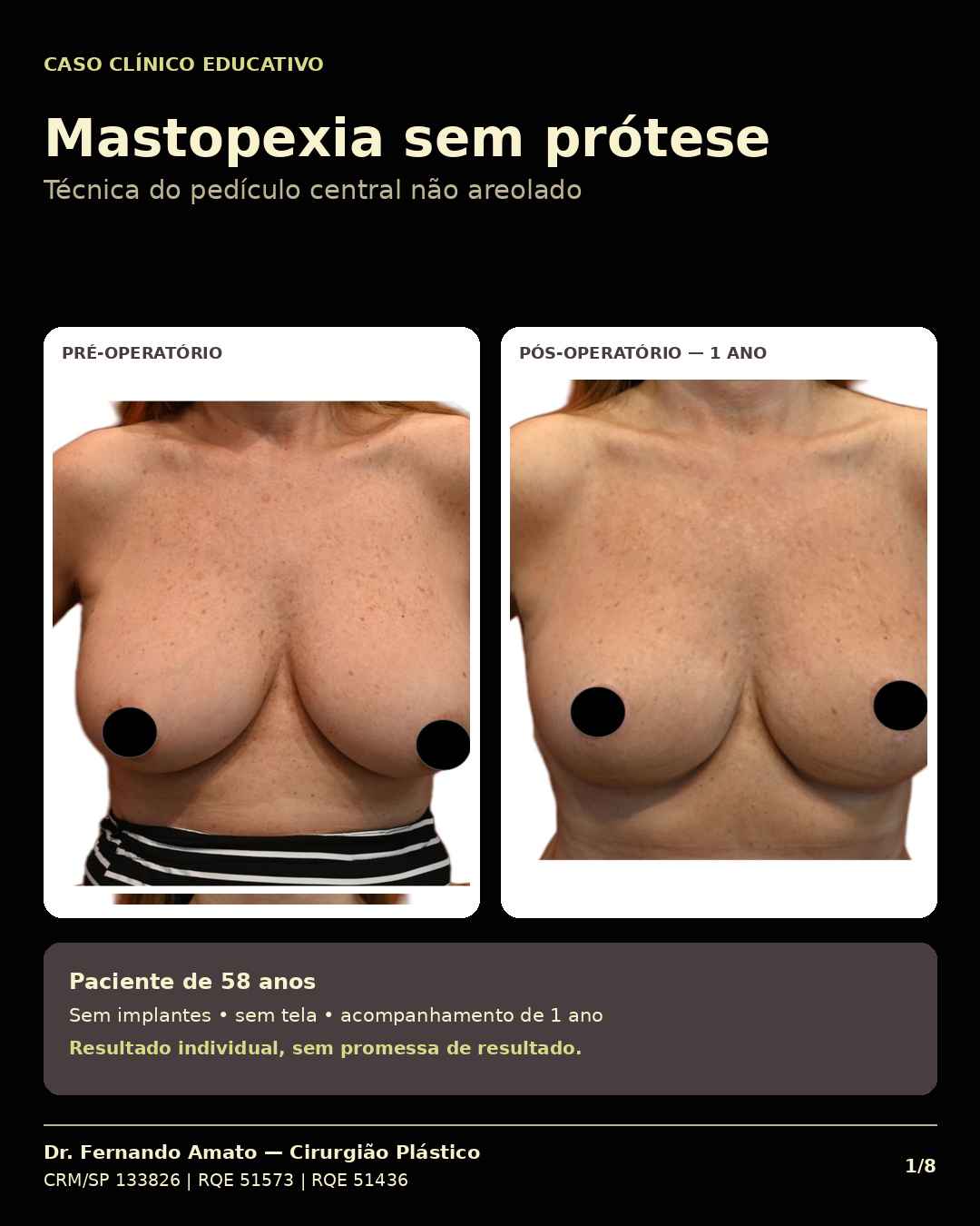 Capa do caso clínico: mastopexia sem prótese com pedículo central não areolado — comparação lado a lado entre pré-operatório e pós-operatório de 1 ano